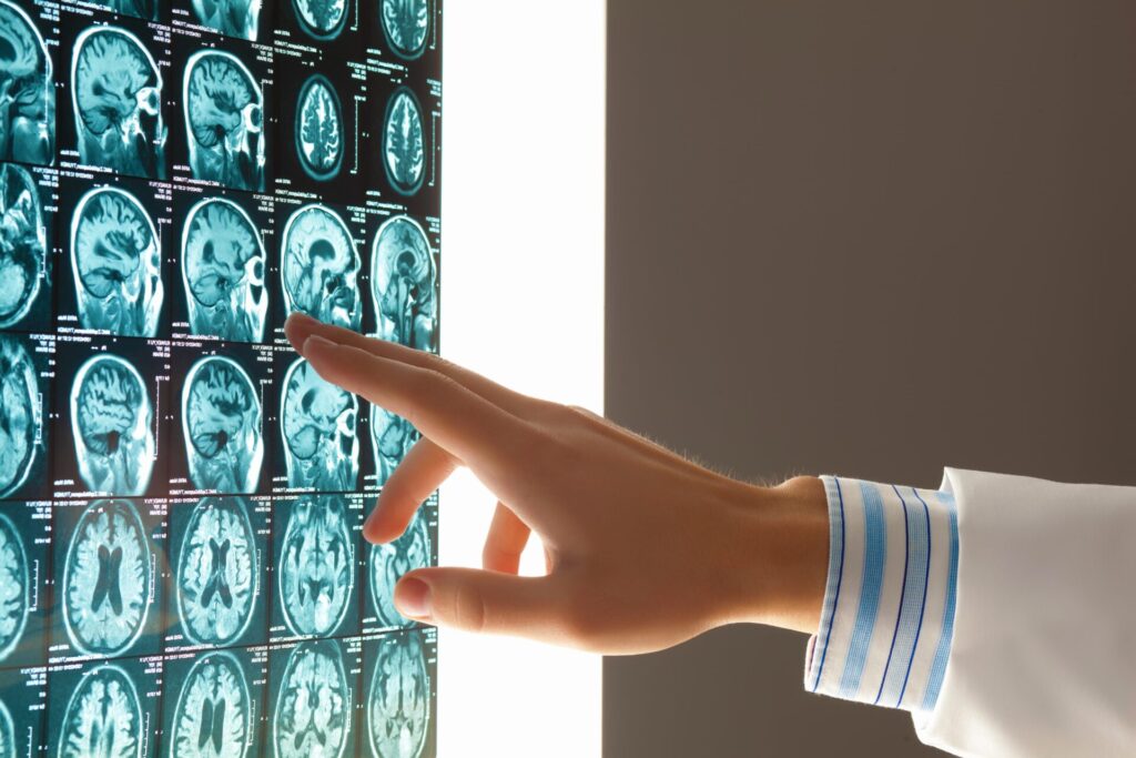 Filing a Claim for a Traumatic Brain Injury from a Car Accident in New York